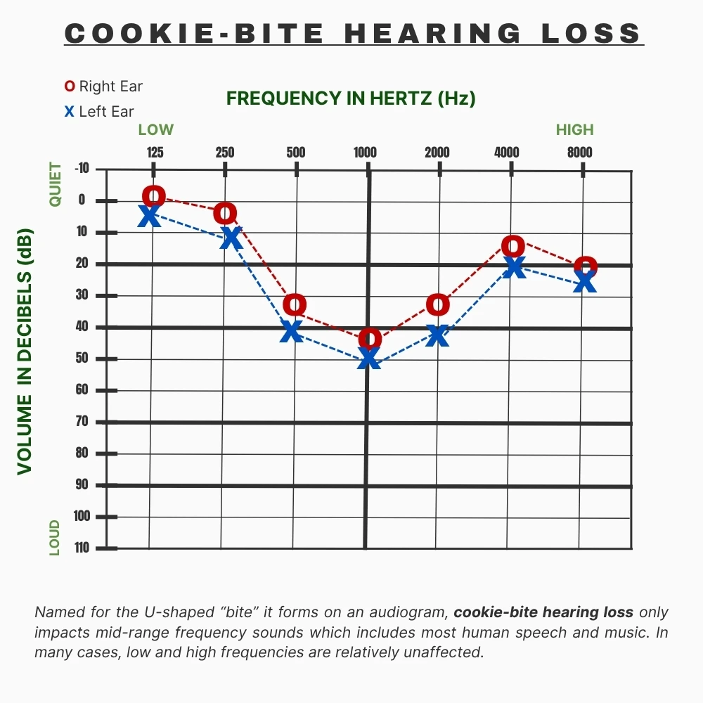 An example of an audiogram graph showing hearing test results that indicate cookie-bite hearing loss. Named for the U-shaped “bite” it forms on an audiogram, this rare condition only impacts mid-range frequency sounds which includes most human speech and music.