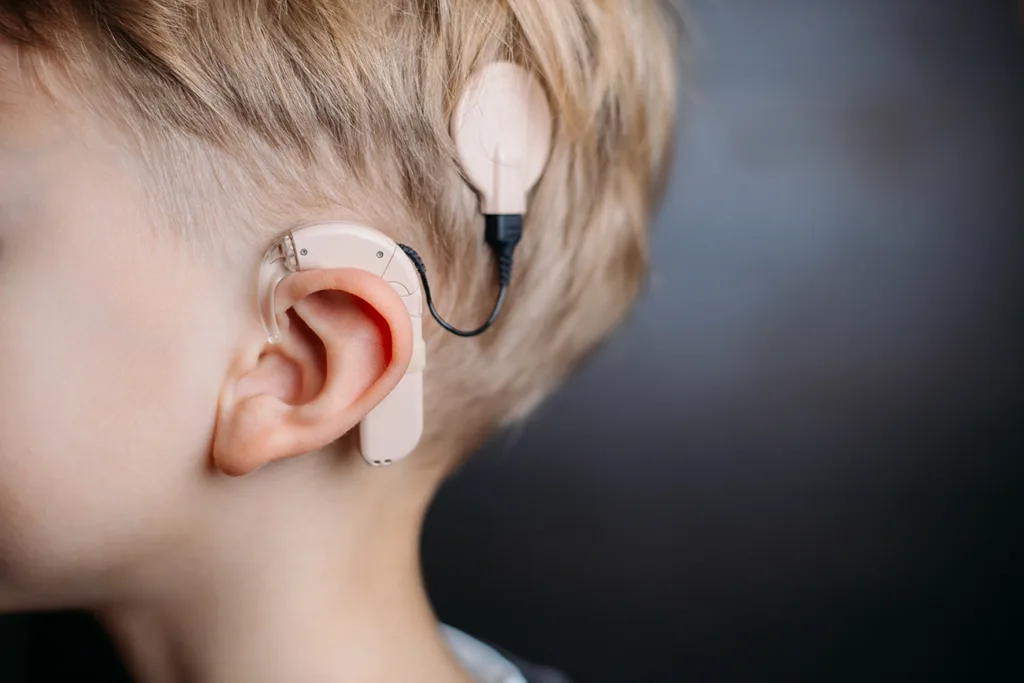 the side profile of a young child with a Surgical Bone-Anchored conduction Hearing Aid