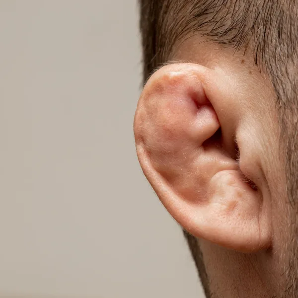 A close up of the side of a man's head, with obvious cauliflower ear.