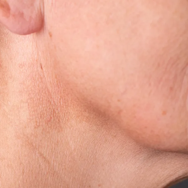 Close up of the side profile, jaw line and ear, of a middle aged person, indicating the areas affected by TMJ-related hearing loss