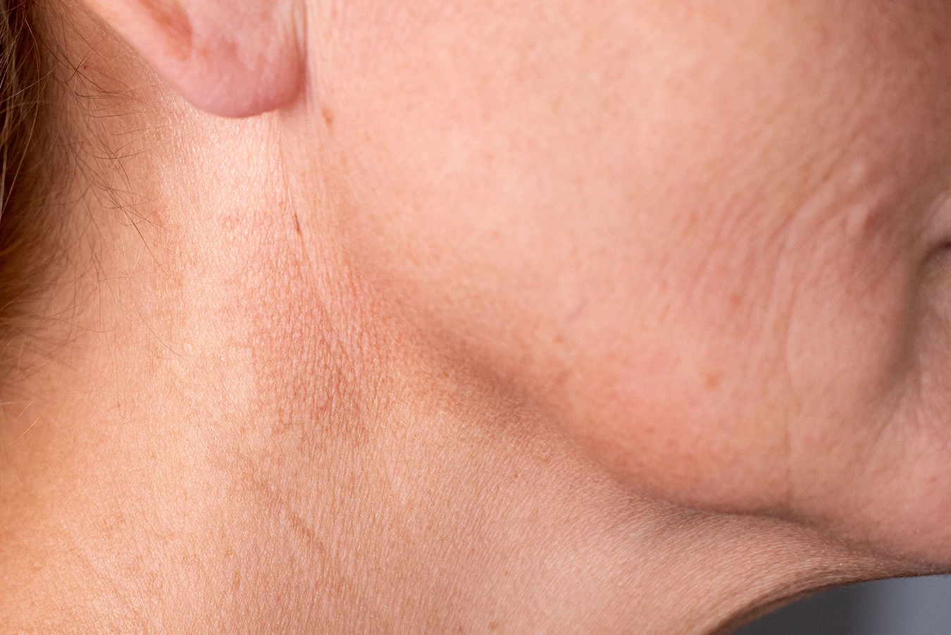 Close up of the side profile, jaw line and ear, of a middle aged person, indicating the areas affected by TMJ-related hearing loss